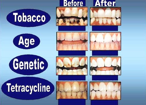 tobacco